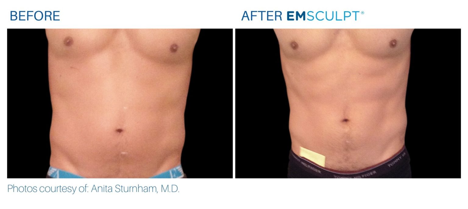 Emsculpt Body Contouring | Burn Fat And Build Muscle